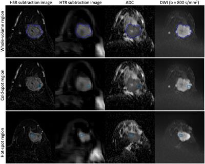 The relationship between parameters measured using intravoxel incoherent motion and dynamic contrast-enhanced MRI in patients with breast cancer undergoing neoadjuvant chemotherapy: a longitudinal cohort study